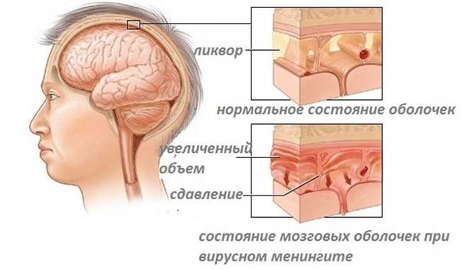 Состояние мозговых оболочек при менингите
