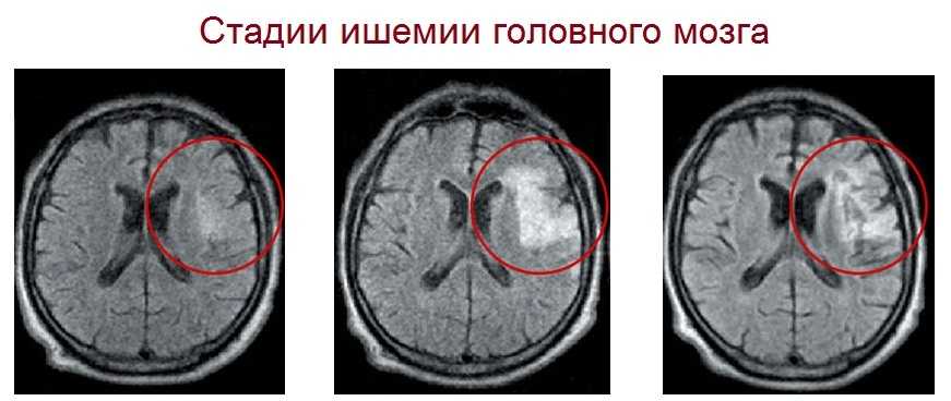Стадии ишемии головного мозга на МРТ