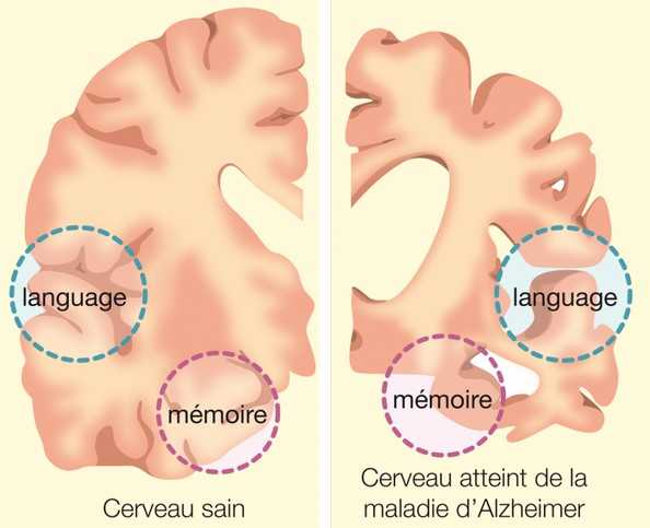 Мозг при деменции
