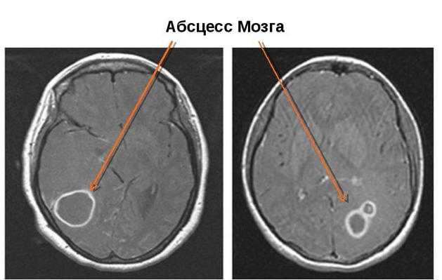 МРТ абсцесса головного мозга