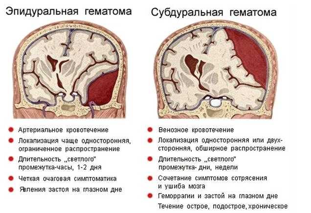 Виды гематом при мозговом кровоизлиянии