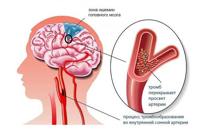 Что такое ишемия головного мозга?