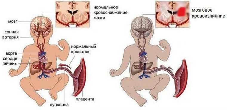 Мозговое кровоизлияние у новорожденных