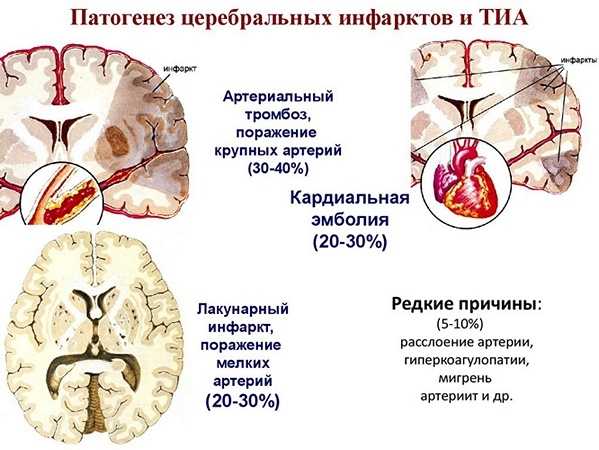Патогенез ТИА и церебрального инфаркта