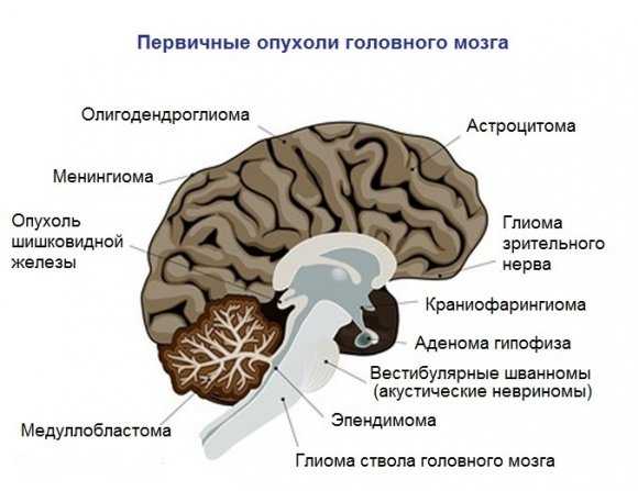Первичные опухоли мозга