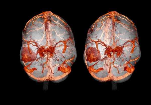 Снимок КТ мозга