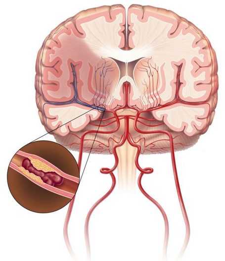 Атеросклеротическая бляшка в сосудах головного мозга