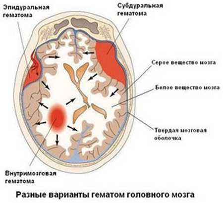 Разные варианты гематом головного мозга