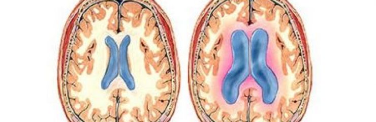 Симптомы и лечение гидроцефалии головного мозга (водянки) у взрослых