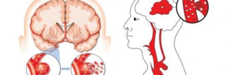 Симптомы и последствия кровоизлияния в мозг