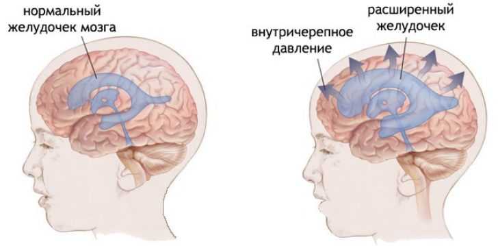 Изображение - Внутричерепное давление у 7 месячного ребенка golovnye-boli-v-lobnoj-chasti-prichiny