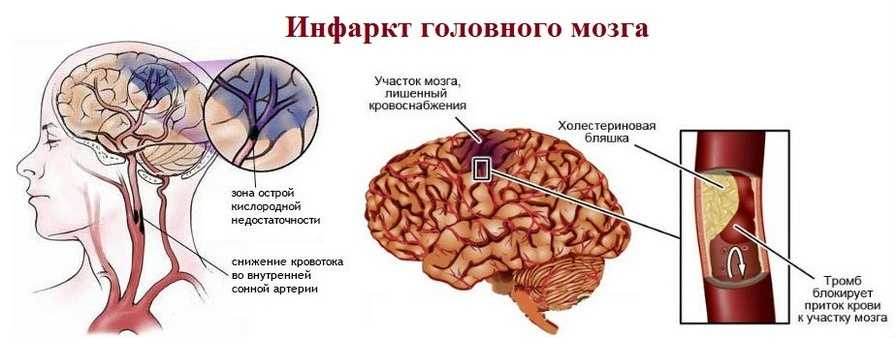 Инфаркт головного мозга