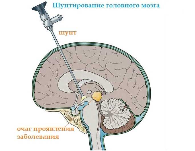 Шунтирование головного мозга