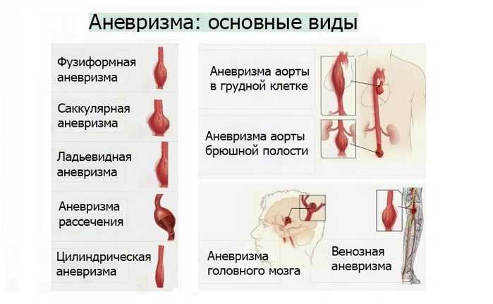 Основные виды аневризмы головного мозга