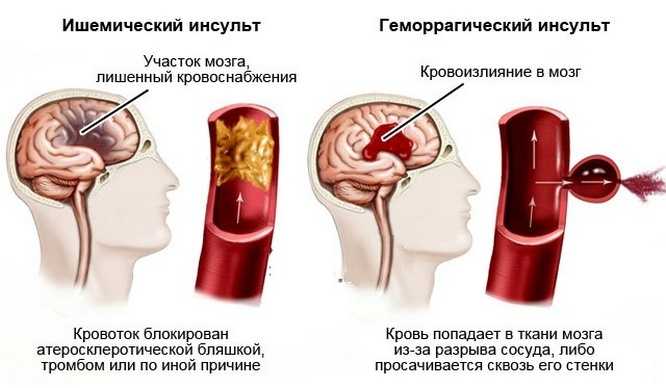 Разные виды инсульта головного мозга