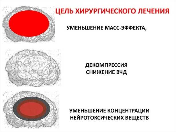 Лечение отёка головного мозга