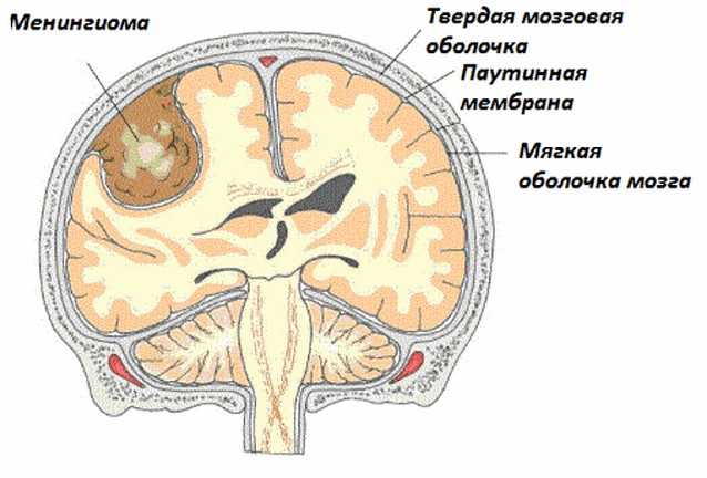 Что такое менингиома головного мозга