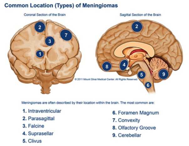 Типы менингиом головного мозга