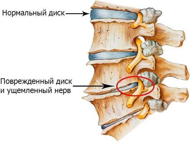 Защемление нервных корешков в шее
