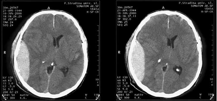 Снимок компьютерной томографии головного мозга
