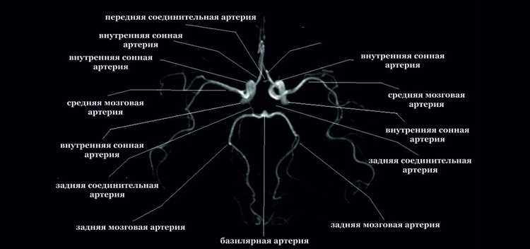 Снимок ангиографии сосудов головного мозга