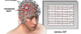 Энцефалограмма головного мозга