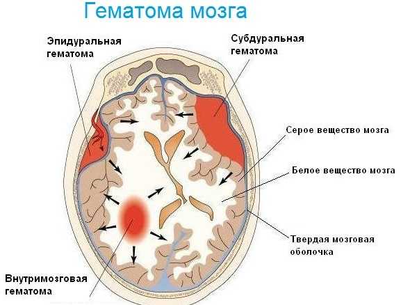 Виды гематом мозга