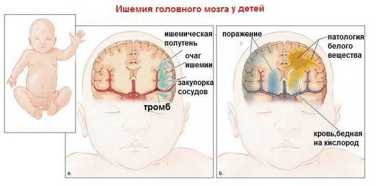 Ишемия головного мозга у детей