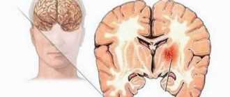 симптомы у опухоли головного мозга