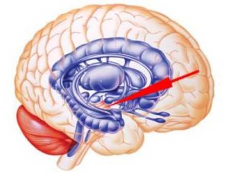 Киста прозрачной перегородки головного мозга