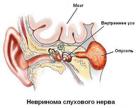 Акустическая невринома слухового нерва